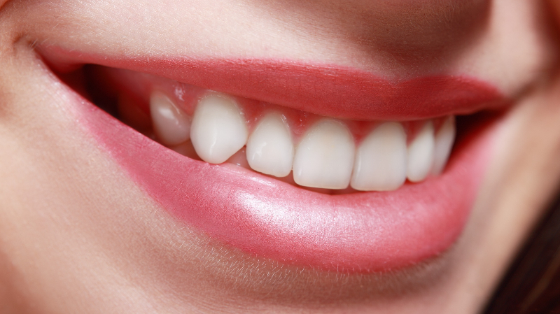 Veneers Vorher Nachher, strahlendes Lächeln