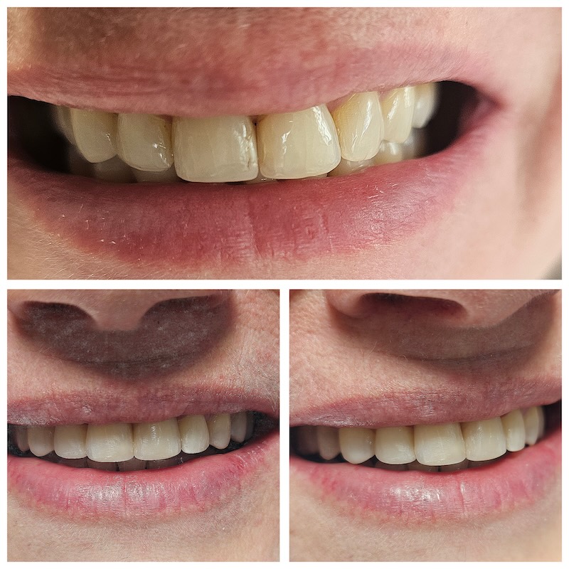gebiss einer Frau mit neuen Veneers in dreifacher Form.